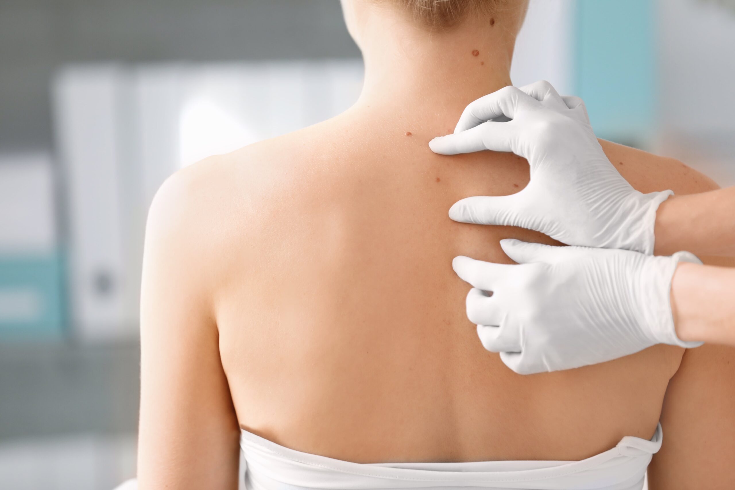 Clinician inspecting mole on patient's back