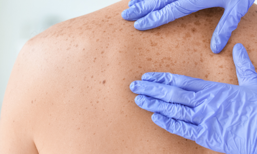 Dermatologist inspecting their patients skin